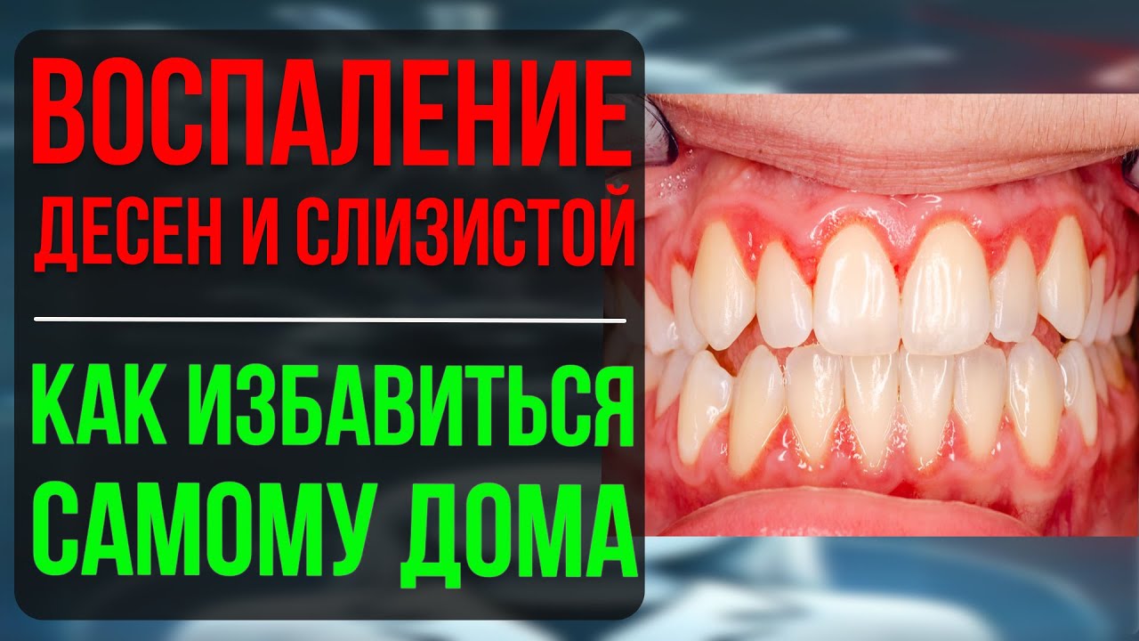 Как быстро снять воспаление десен и слизистой оболочки дома