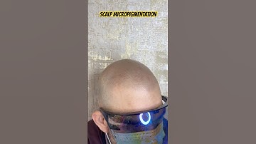 Scalp micropigmentation for hairloss, 3 sessions beautiful results #scalpmicropigmentation #smp