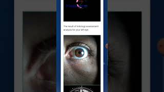 Upload a photo of your eyes,then find out about yourself!Iridology+Image processing+Machine learning