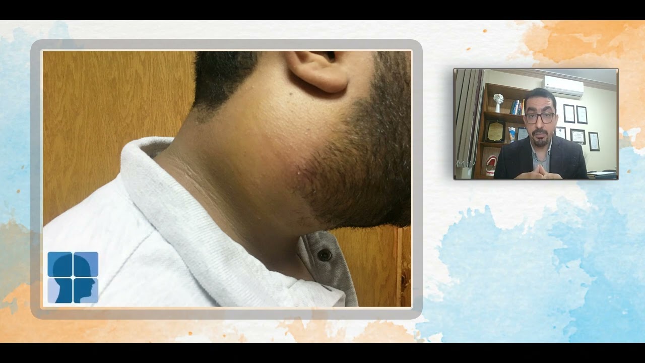 الكيس الخيشومي بالرقبة .. الأنواع والتشخيص والعلاج (2)