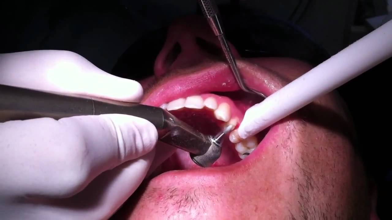 Chamfer prep on a live patient YouTube