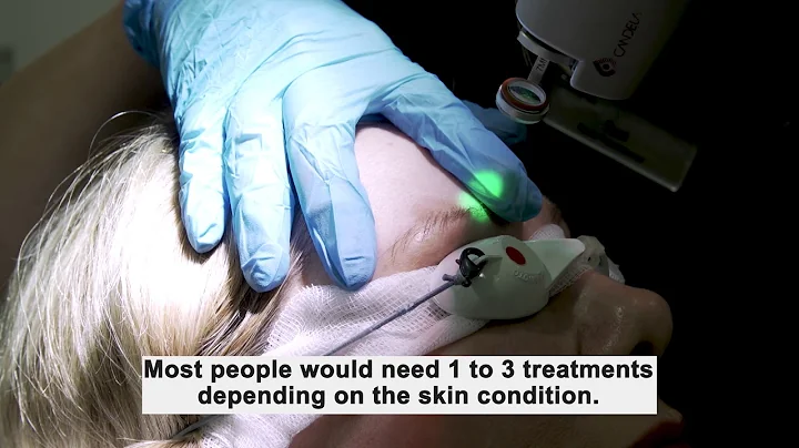 VBEAM Pulse Dye Laser | Facial Treatments | Karidis Clinic
