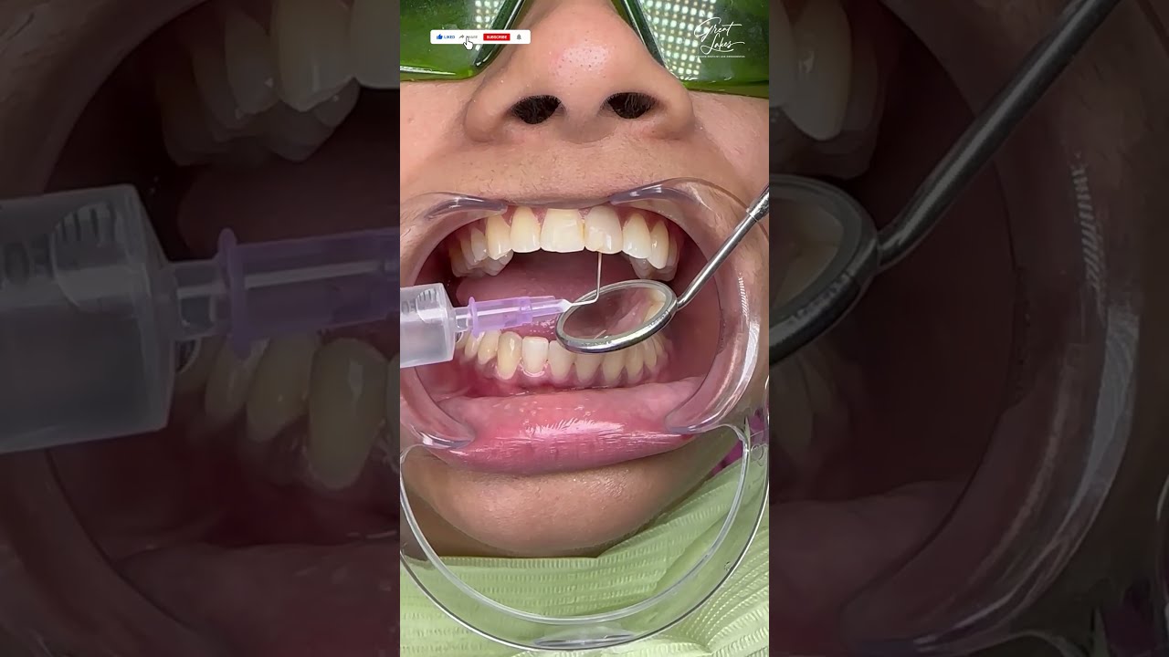Root Canal Treatment In Kolkata RCT Procedure Step By Rootcanaltreatment Dental Dentistry