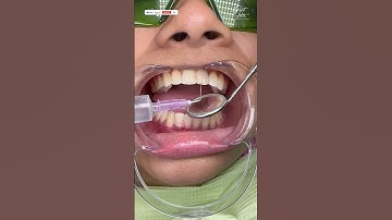 Root Canal Treatment in Kolkata | RCT Procedure Step by Step- #rootcanaltreatment #dental #dentistry