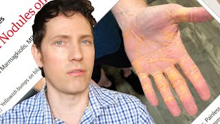 New Carnivore Diet Symptom: Cheese Hands