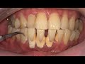 REMOVE TARTAR | SCALING | Dentist | Dokter Gigi Tri Putra