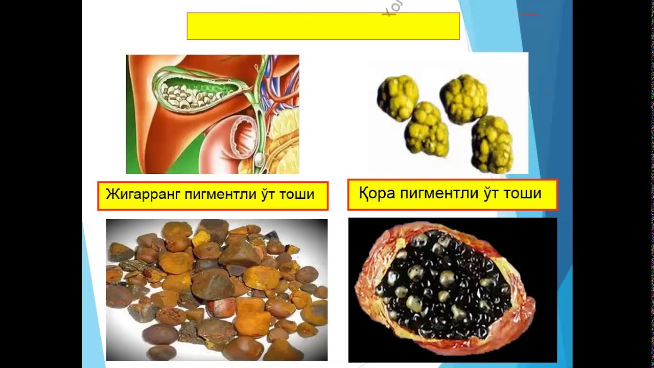 Терапия желчного пузыря. Острый калькулезный холецистит и желчекаменная болезнь. ЖКБ острый калькулезный холецистит. Камни желчного пузыря патанатомия. Калькулезный холецистит макропрепарат.