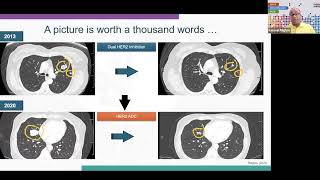 Evolving role of HER2/ERBB2 targeting in Colorectal cancer: 2026 Updates- Dr. Kanwal Raghav