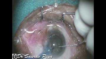 DEEPLY SEATED EYE - BROWN CATARACT - PHACOEMULSIFICATION - Dr Saurav Piya
