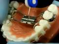 Bracesquestions.com - Orthodontic Jaw Expander, How to Turn