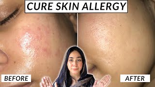 How To Cure Skin Allergy | Honest Skincare | Shamaim Rajpoot