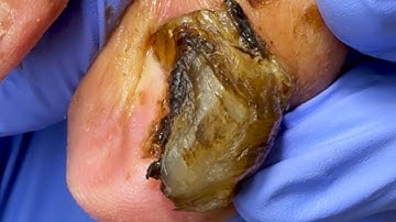 The Toenails Are Like A Big Black Stone  Cut Them All Off【Dr  Liu