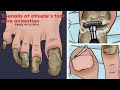Asmr satisfying toenail of athletes foot treatment animation  athletes foot foot care  tingles