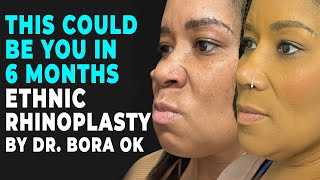 This Could be You in 6 Months | Ethnic Rhinoplasty by Dr. Bora Ok