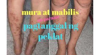 Paano Maalis Ang PEKLAT?|| MURA AT MABILIS NA PARAAN PAGTANGGAL NG PEKLAT