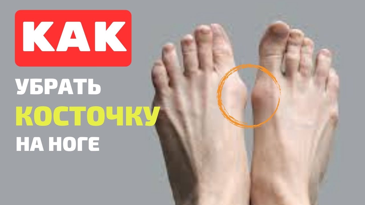 Вальгусная стопа: что делать, если вылезла КОСТОЧКИ НА НОГЕ? \\ЗДОРОВЬЕ ...