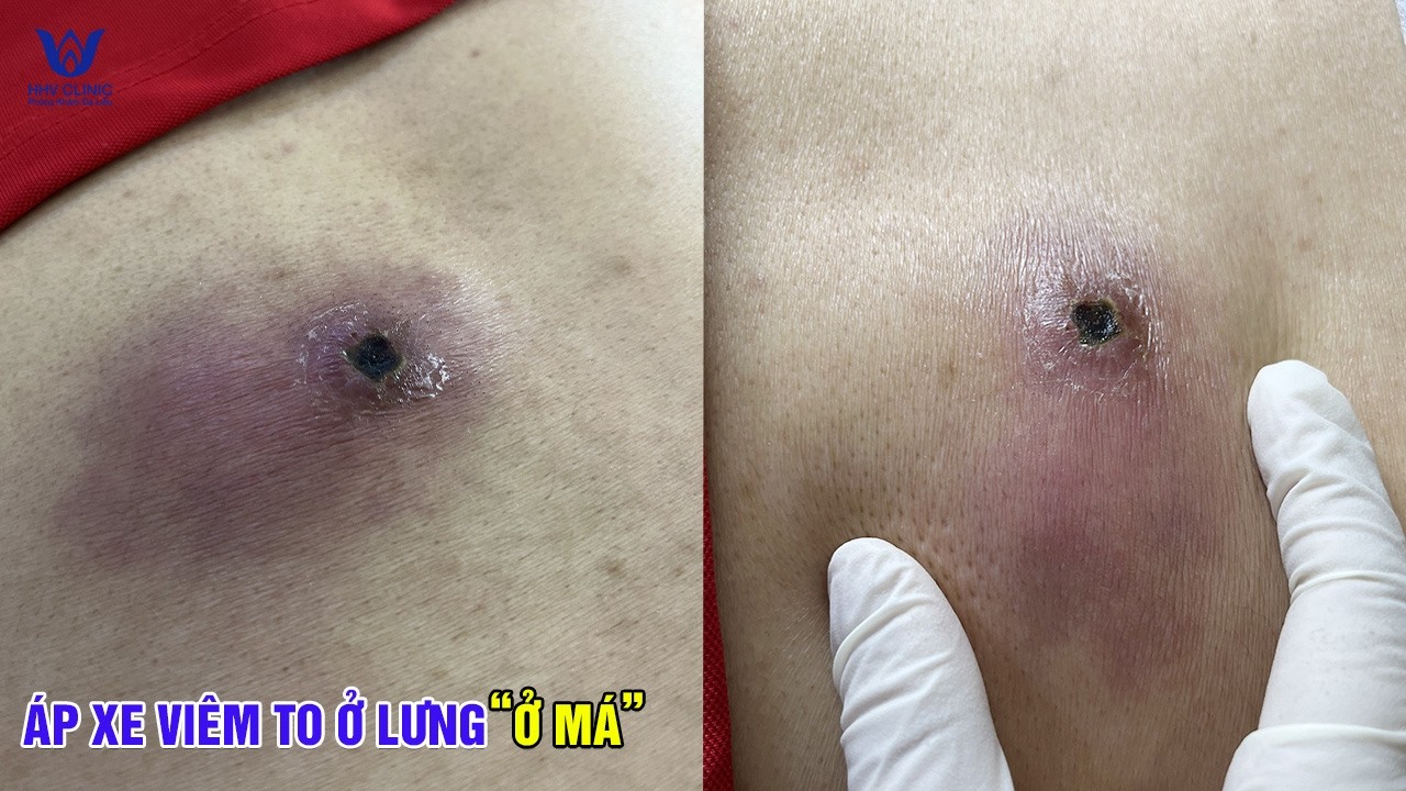 MỤN VIÊM NẶNG CHUYỂN THÀNH ÁP XE – XỬ LÝ ĐÚNG TRÁNH SẸO.