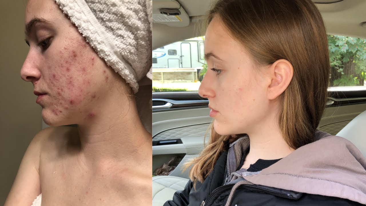 How I actually cleared my cystic acne (emotional) - YouTube