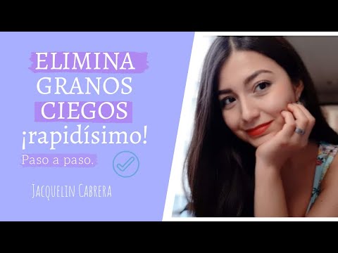 Видео: Espinillas Ciegas Debajo De La Piel: 6 Formas De Tratarlas