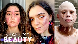 Accepting Our Acne Has Made Us Stronger | SHAKE MY BEAUTY