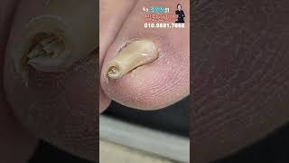 반으로 접혀진 내성발톱 #shorts #내성발톱 #무좀발톱 #무좀관리 #ingrown #toenails