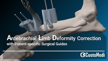 Antebrachial limb deformity correction with patient-specific surgical guides