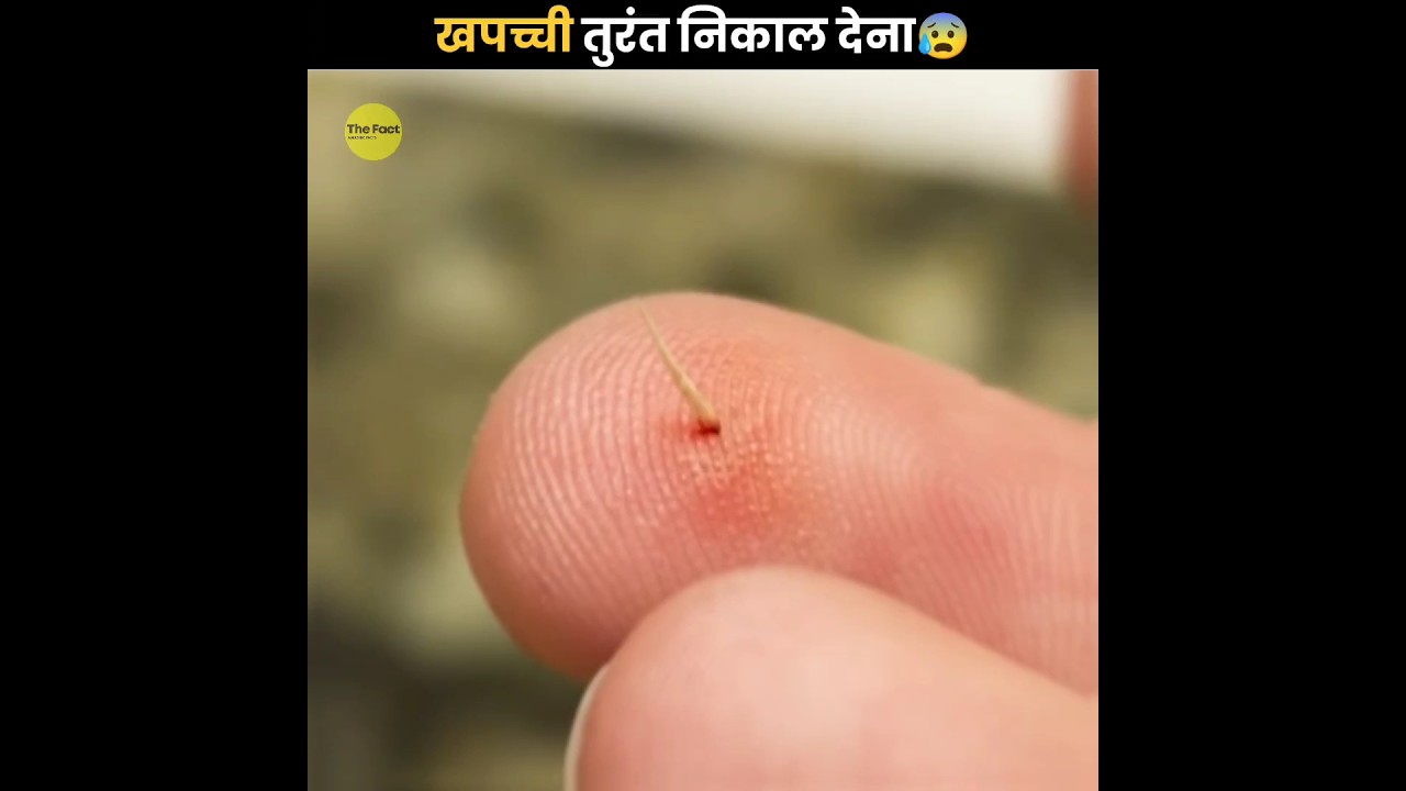 Splinter को तुरंत निकाल देना 😰 | Remove Splinter Immediately | The Fact | #shorts #ytshorts