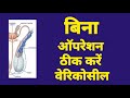 बिना ऑपरेशन ठीक करें varicocele. डॉ मनीष गुप्ता, होम्योपैथ, रायबरेली, U.P., Mob 7607480018.