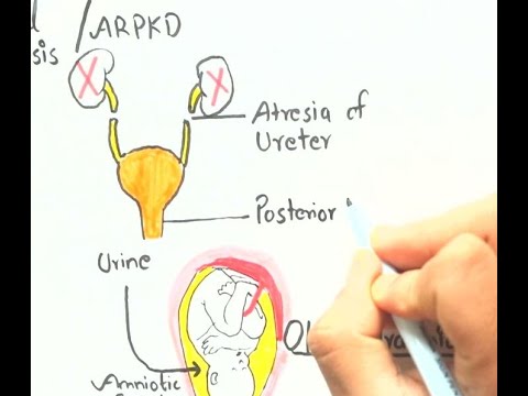 Potter (Oligohydramnios) sequence/ Potter syndrome + Mnemonic