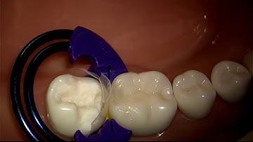 Bioclear Matrix | Chapter 3: Injection Molding A Modern Class II