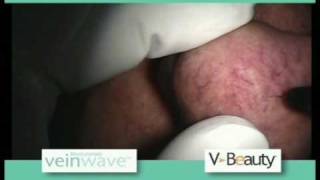 Rosacea comentários veinwave