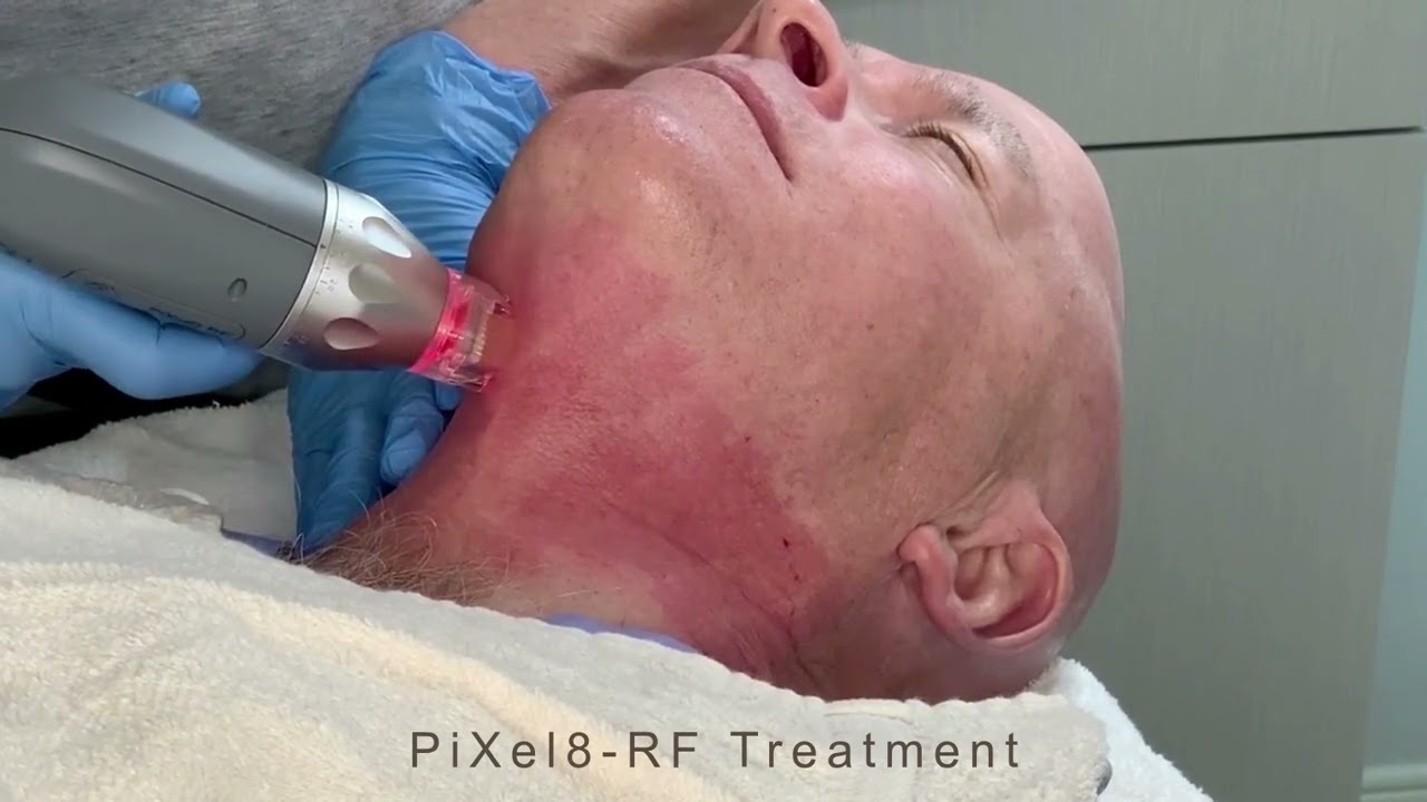 Pixel8-RF Skin Tightening Device in Jackson, MS | Faces, PLLC