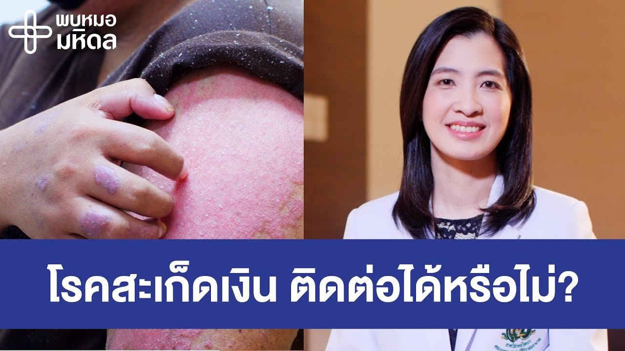 โรคสะเก็ดเงิน โรคผิวหนังจากพันธุกรรม | พบหมอมหิดล [by Mahidol Channel]