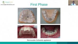 Dr. Llanes Case Presentation- Invisalign, Braces, UConcept, UStart, Schwartz