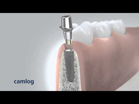 CAMLOG 3D Implantation