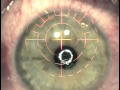 My LASIK with IntraLase