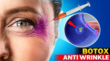 How Botox Works | How Does Botulinum Toxin Work? Botox lasts how long