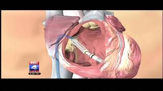 FOX: FDA Approves the World's Smallest Pacemaker - Micra