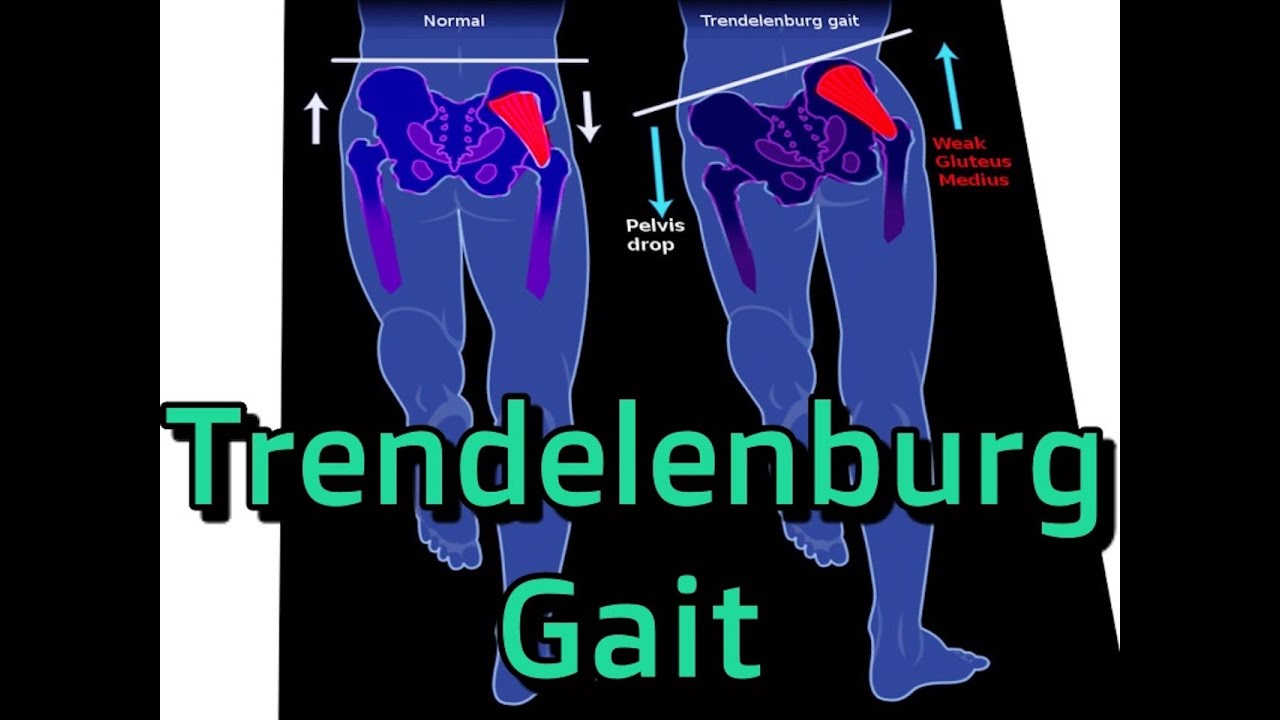 Trendelenburg Gait Explained and How to Fix YouTube