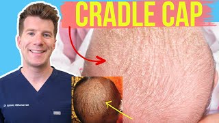 Doctor explains CRADLE CAP (Seborrheic dermatitis) in babies & infants | Photos and home treatment!