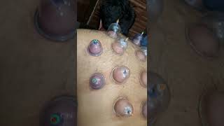 Dry Cupping 😎😎 #ahorts #trendingshorts #viralvideo #painfree #physiotherapy #cupping #drycupping #pt