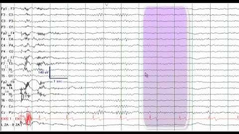 EEG Reading Rounds (EEG in Frontal Lobe Epilepsy)