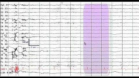 EEG Reading Rounds (EEG in Frontal Lobe Epilepsy)
