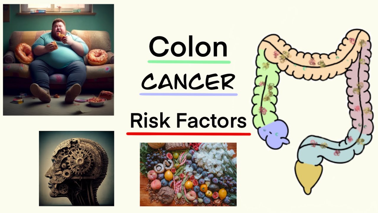 Colon Cancer (Risk & Preventative Factors) - YouTube