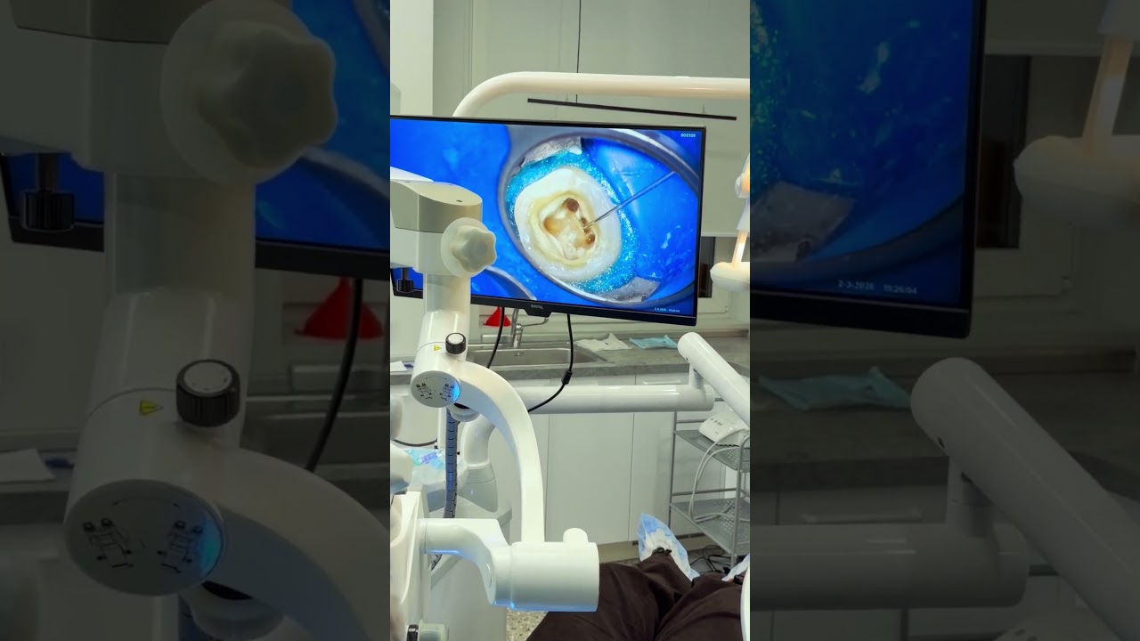 6 каналов в одном зубе - лечим с микроскопом