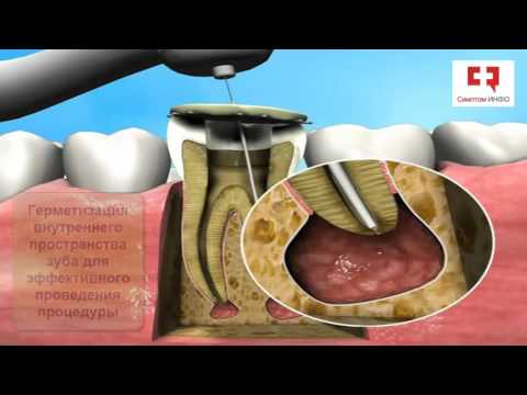 Лечение кисты зуба без операции