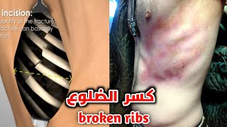 شاهد كيف يتم تثبيت الضلوع المكسورة_Fixation of broken ribs