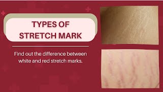 All You Need To Know About Stretch Marks: Types of Stretch Mark on Body & How to Differentiate?