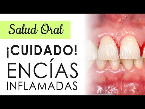 Vídeo: ¿Por Qué Me Duelen Las Encías? Razones Y Tratamiento Para El Dolor De Encías