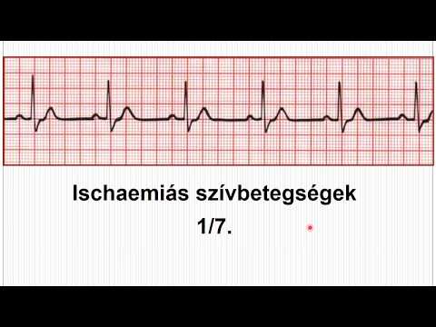 Videó: Funkcionális és Diszplasztikus Kardiopátia, Ischaemiás és Másodlagos